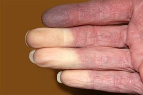 Raynaud